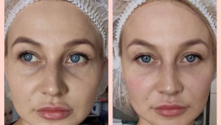 Мезо глаз фото Мезо глаз фото