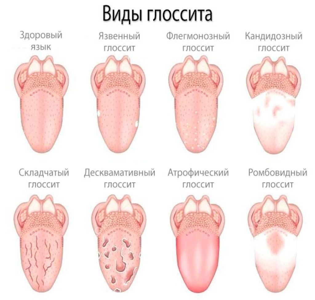 Кончина язык. Глоссит этиология патогенез. Десквамативный глоссит налет. Срединный ромбовидный глоссит.